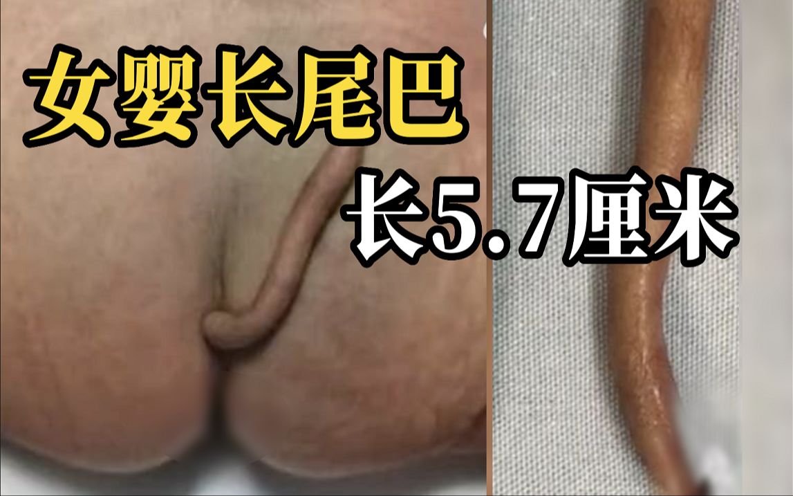 [图]女婴出生时长5.7厘米尾巴 其他发育一切正常