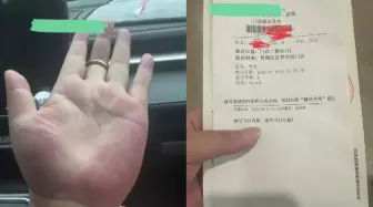 Tải video: 女子晒手掌被网友提醒查肝功能，隔天去医院做检查：几项都有问题