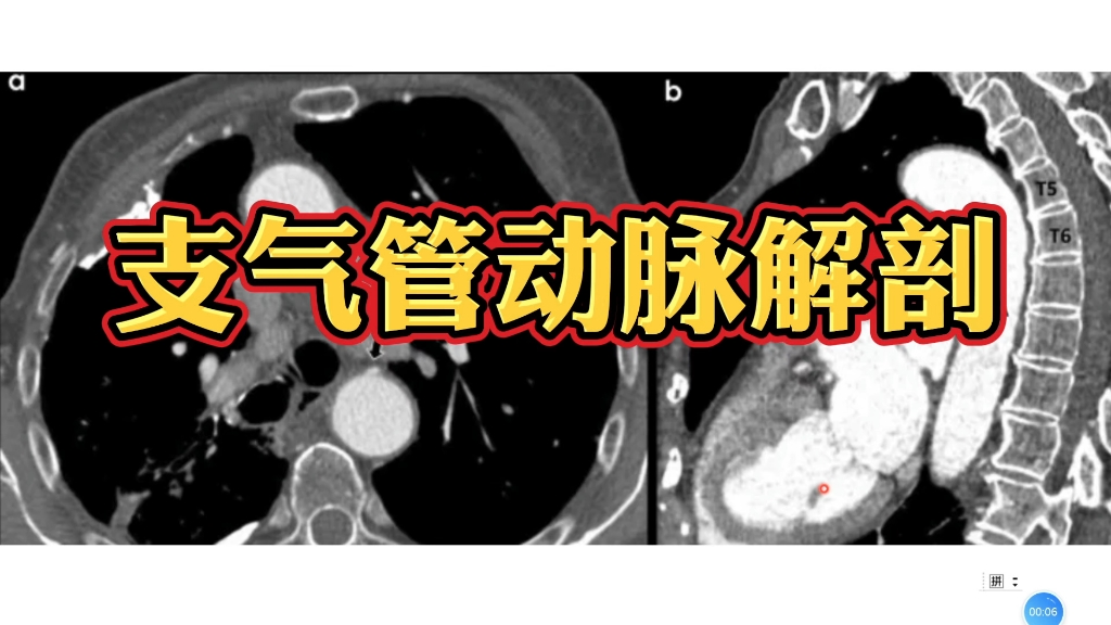 支气管动脉解剖及分型讲解,赶紧收藏学习!哔哩哔哩bilibili