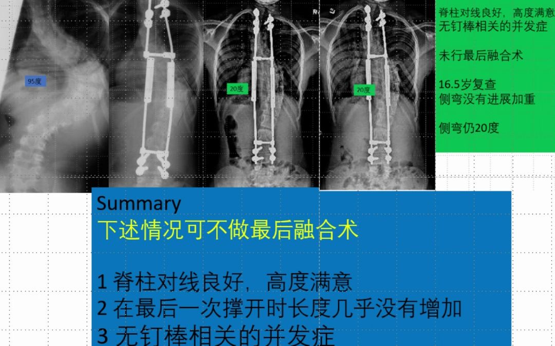 6岁男孩 脊柱侧弯 95度,传统生长棒(TGR)非融合技术矫正效果满意,未行最终融合术,侧弯竟然没有加重哔哩哔哩bilibili