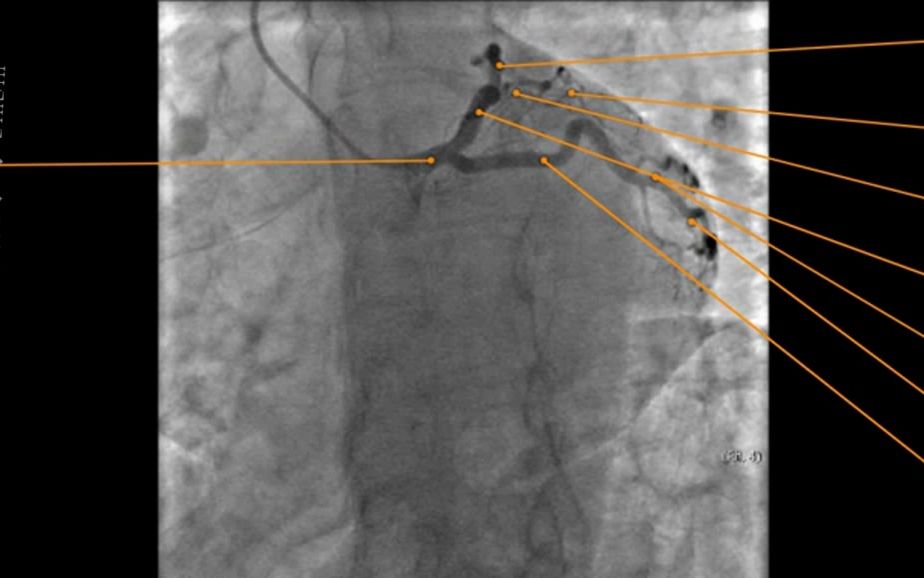 8.心血管影像解剖圖譜-冠狀動脈造影dsa編號命名法-左冠狀動脈解剖