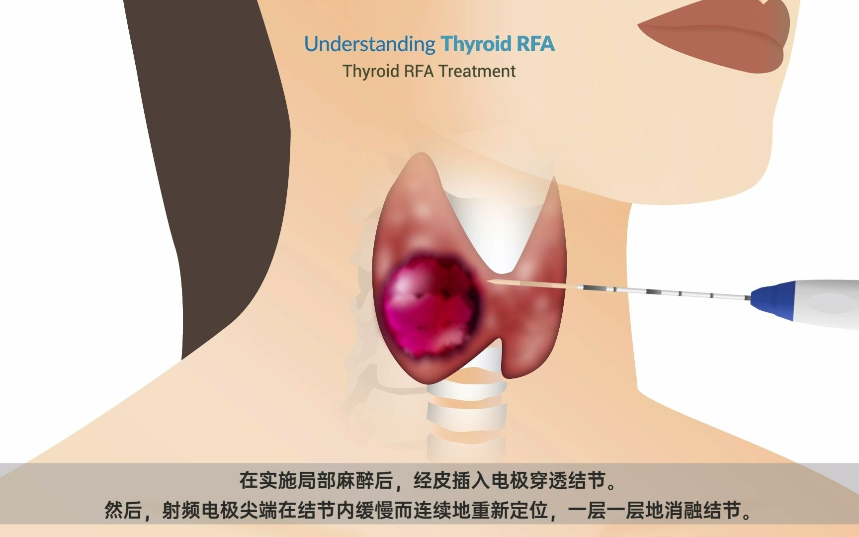 【RF Medical爱尔富】甲状腺射频消融系统哔哩哔哩bilibili