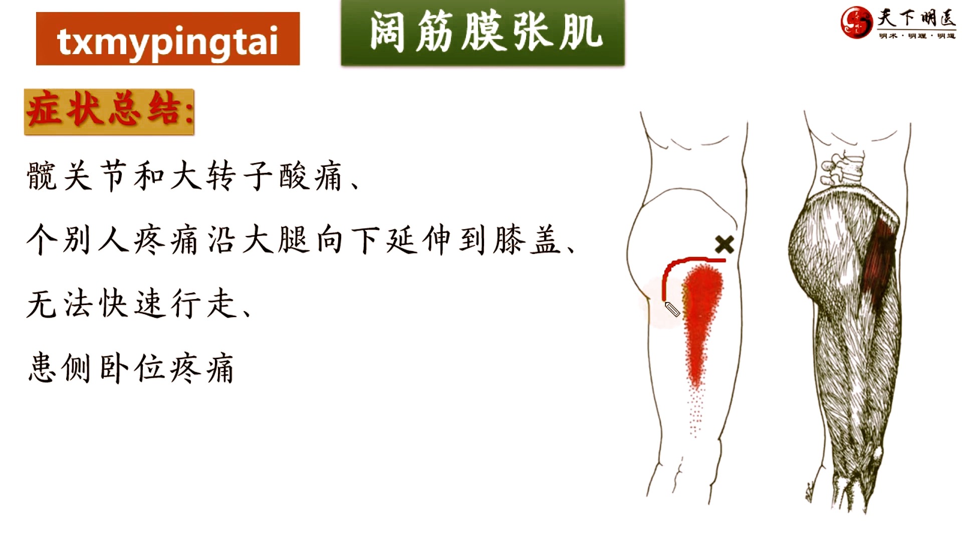 阔筋膜张肌的位置、阔筋膜张肌的功能、阔筋膜张肌的激痛点、阔筋膜张肌损伤后的症状、阔筋膜张肌的处理方法4个方面全方位讲解——天下明医平台简灵...