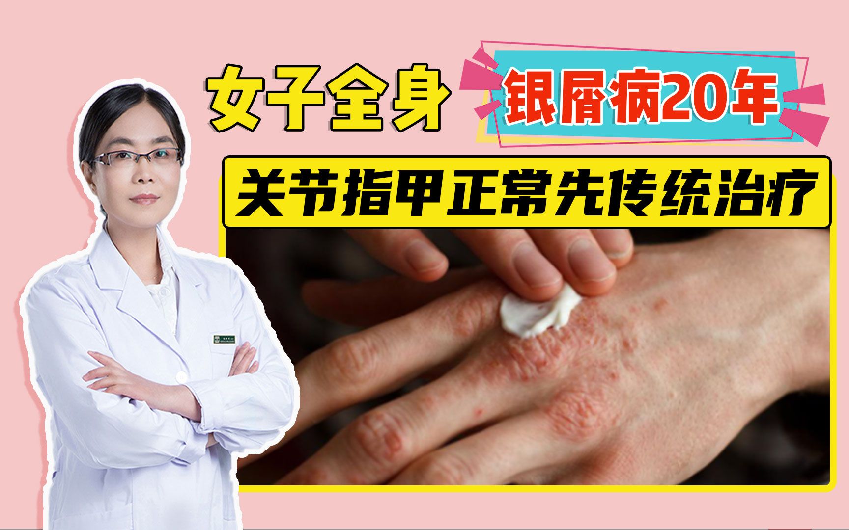 女子全身银屑病20年 关节指甲正常先用传统治疗