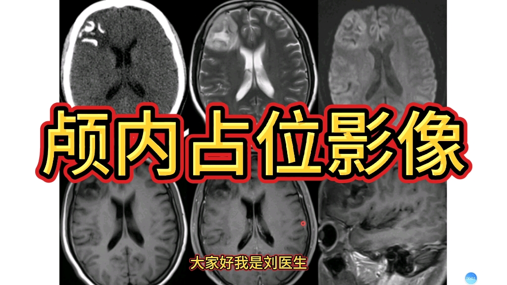 中年女性,偶然发现颅内占位,CT和MRI上如何诊断?医生讲解!哔哩哔哩bilibili