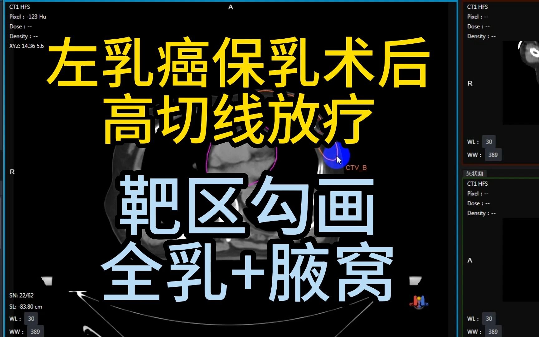 内乳淋巴结靶区勾画图片