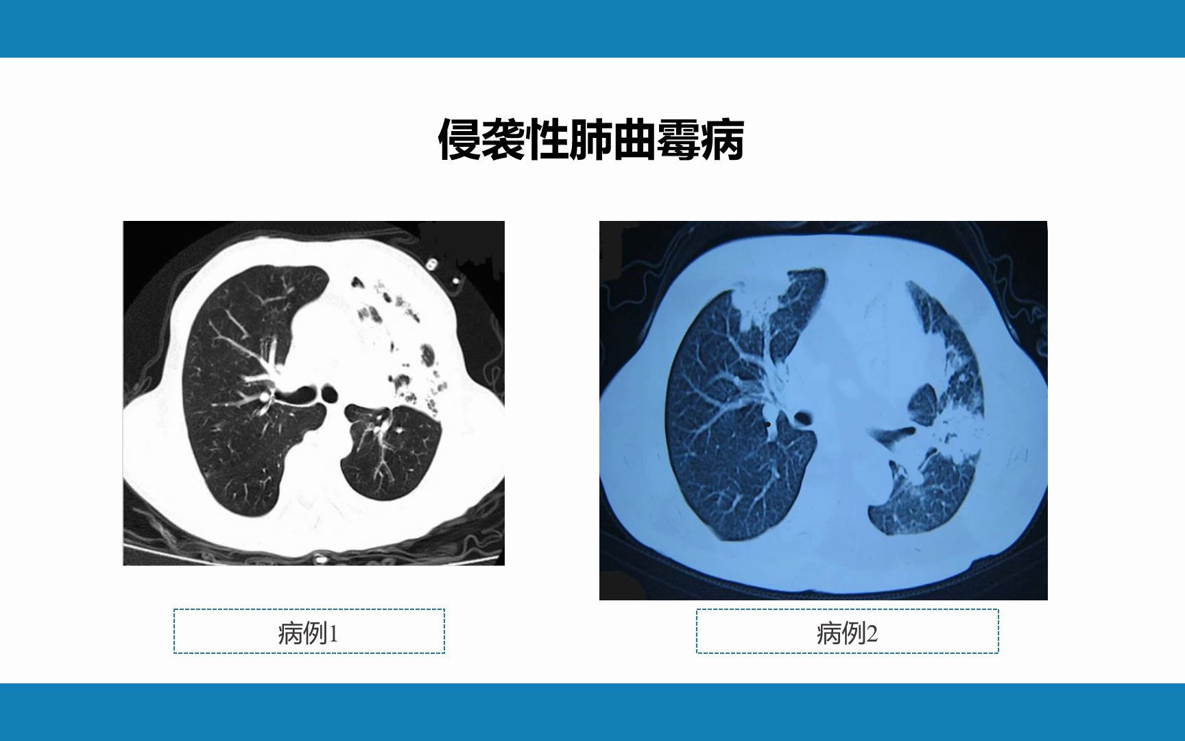 [图]肺部感染性疾病，呼吸系统疾病PPT