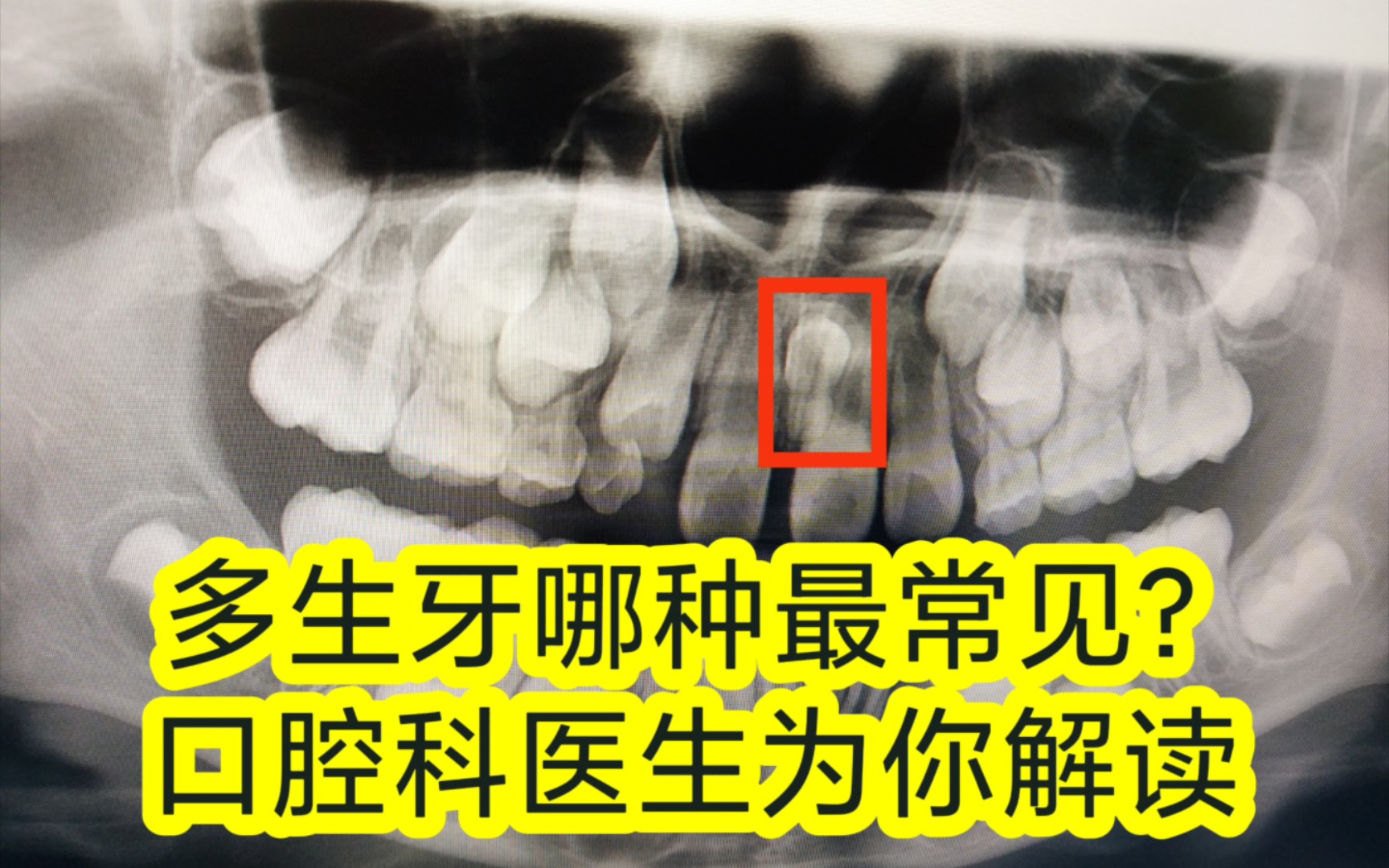 【大白话讲口腔】【牙科医生】什么是多生牙?多生牙哪种最常见?哔哩哔哩bilibili