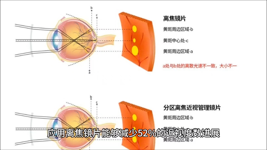 什么是离焦眼镜