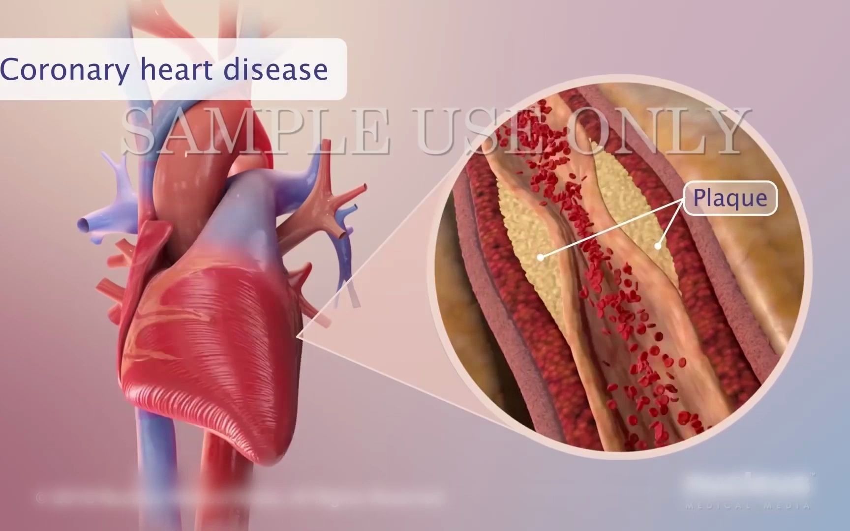 Diabetes and heart disease哔哩哔哩bilibili