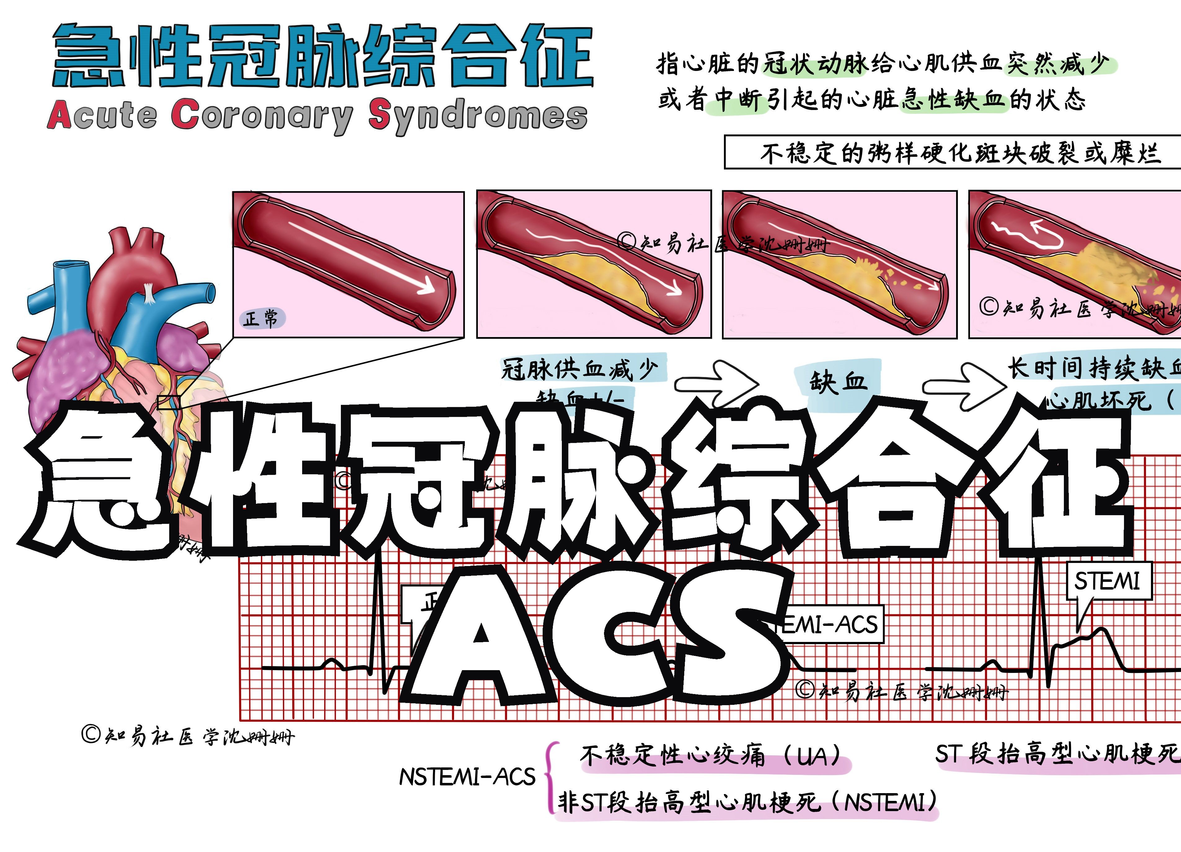 医学手绘笔记 急性冠脉综合征 | 不稳定性心绞痛+非ST段抬高心梗+ST段抬高心梗哔哩哔哩bilibili