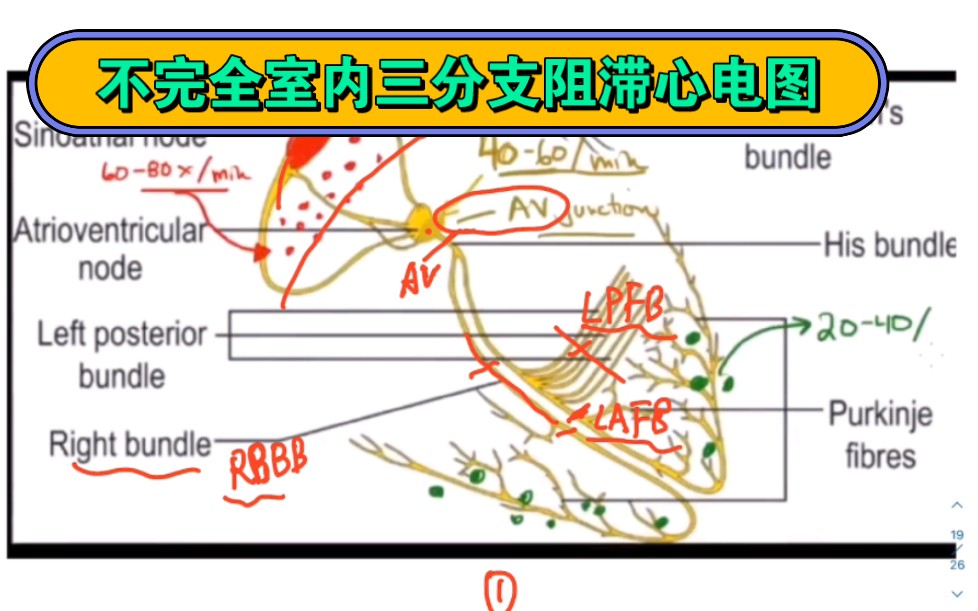 1、窦性心律;2、电轴左偏;3、一度房室传导阻滞;4、右束支阻滞并左前分支阻滞5、avl v3异常Q波,stt改变哔哩哔哩bilibili