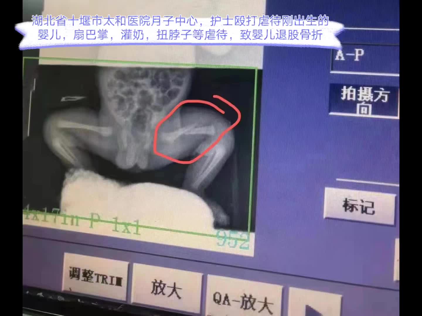 湖北省十堰市太和医院月子中心,护士殴打虐待刚出生婴儿,导致孩子股骨骨折哔哩哔哩bilibili