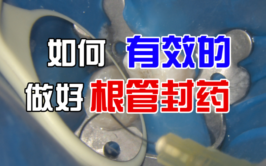 如何有效的完成的根管封药.