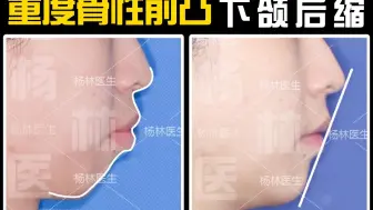 Download Video: 【正畸博士】24岁女生重度骨性前凸＋下颌后缩＋严重牙性问题，通过牙齿矫正一步到位解决！