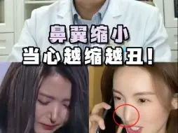 Télécharger la video: 鼻翼缩小👃避免越缩越丑！