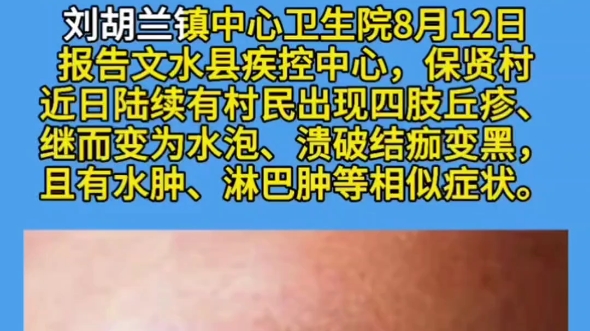 山西文水县发生疑似皮肤炭疽疫情哔哩哔哩bilibili