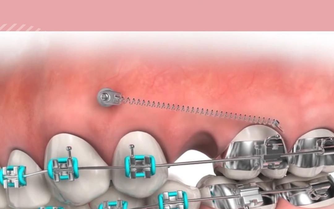 牙齿矫正 打骨钉