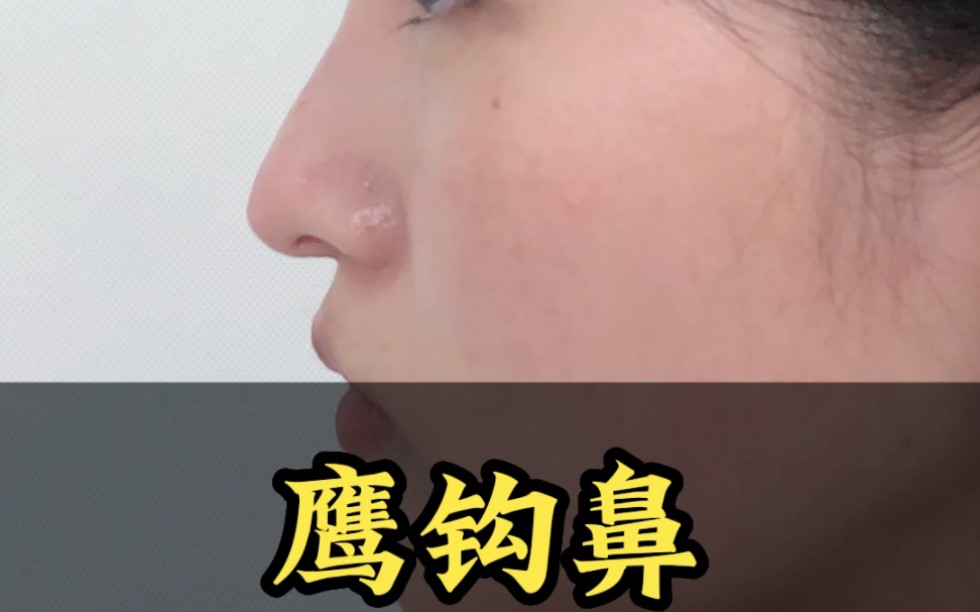 鼻型 #变美 #鹰钩鼻