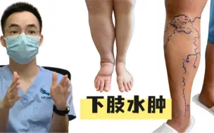 Descargar video: 下肢水肿的诊断思路