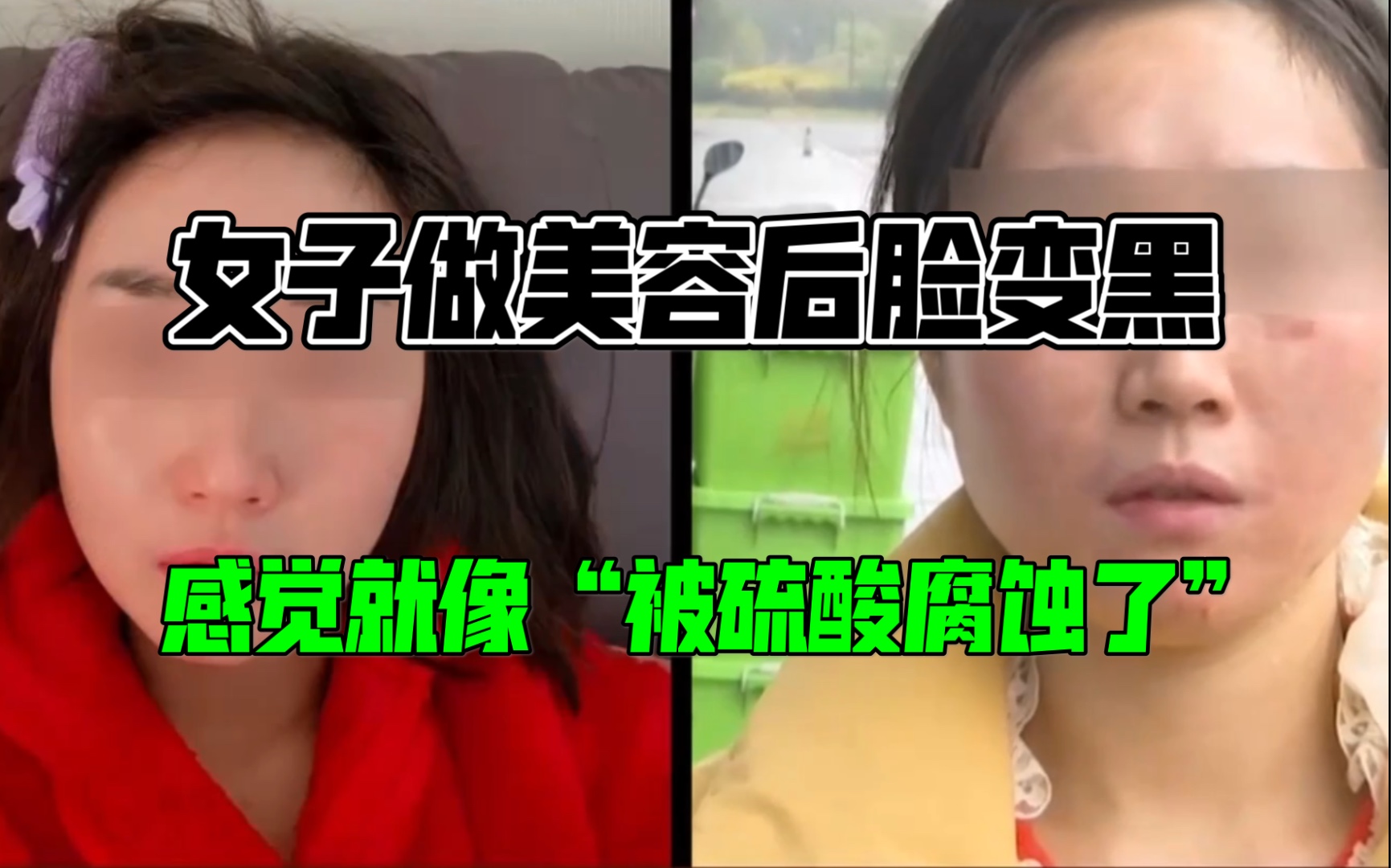 女子做美容后脸变黑,感觉就像“被硫酸腐蚀了”哔哩哔哩bilibili