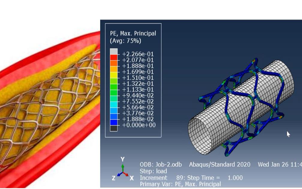 (详细教程)血管支架介绍及数值仿真教程(Abaqus)哔哩哔哩bilibili