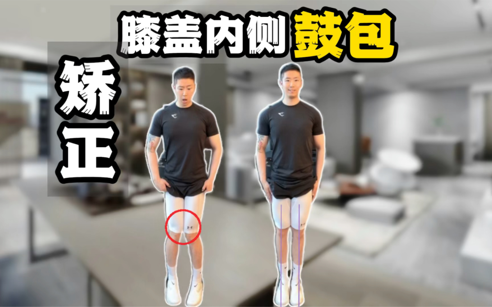 矫正|膝盖内侧鼓包|居家跟练