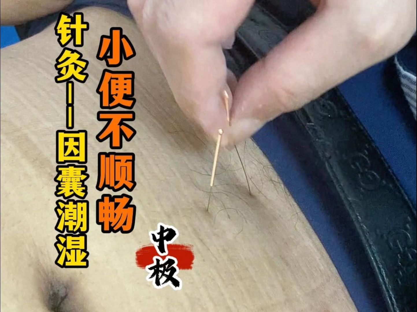 针灸--阴囊潮湿 小便不顺畅