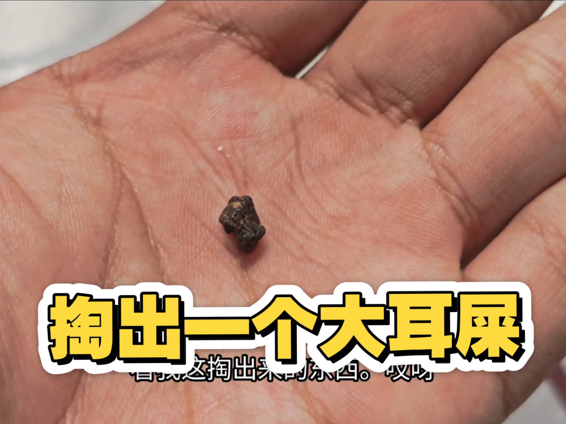 今天休息去医院检查一下耳朵,掏出来了一个大耳屎,又黑又硬