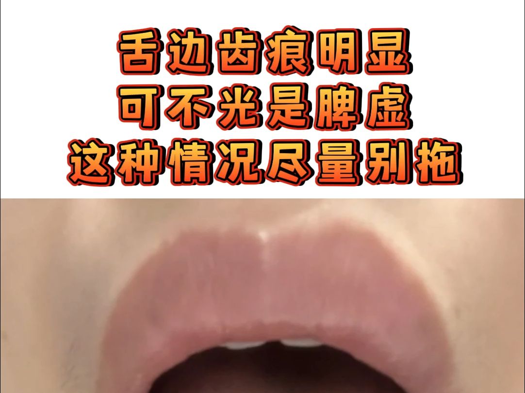 舌头有齿痕是怎么回事图片