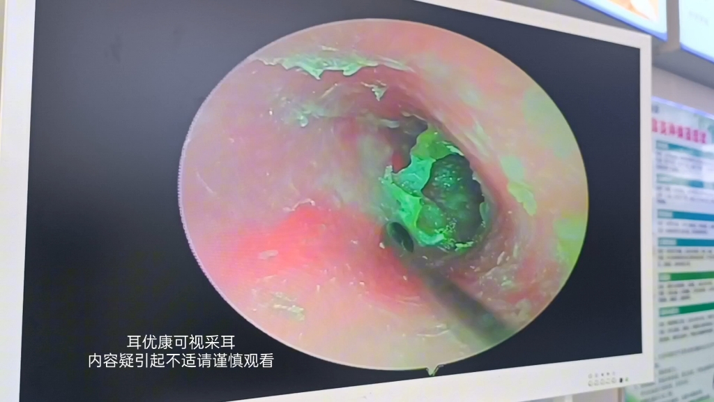 可视采耳解压小视频,耳道发炎感染长了霉菌,影响听力了哔哩哔哩bilibili