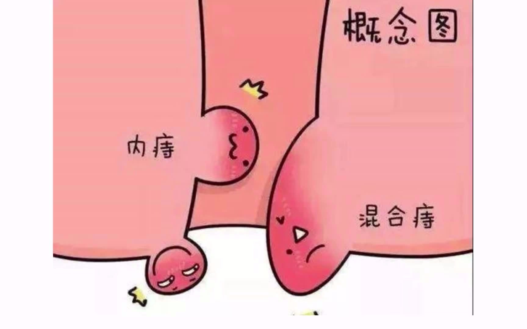 痔疮的分类哔哩哔哩bilibili