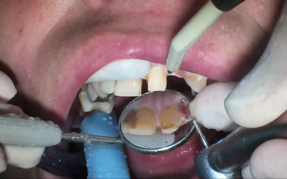 牙科视频:补牙