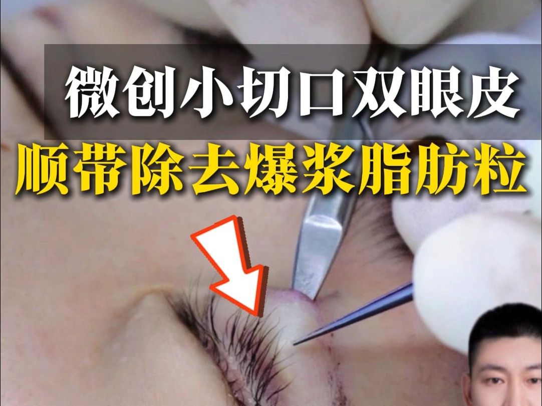 微创小切口双眼皮,顺带除去爆浆脂肪粒