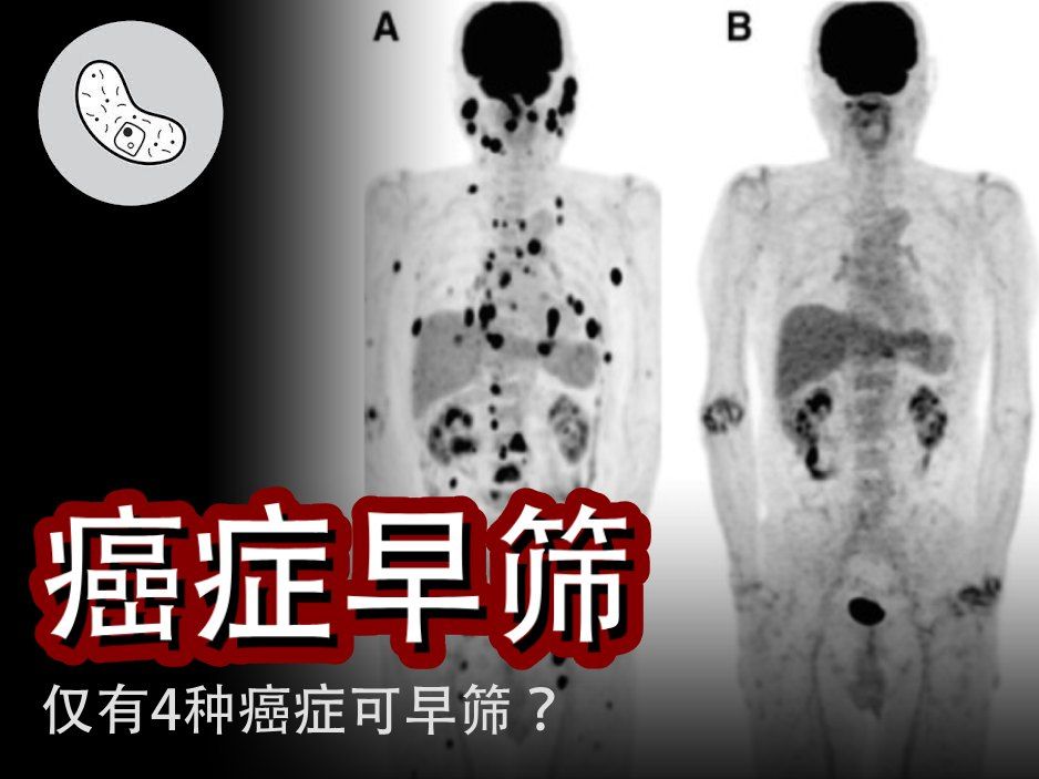 【癌症早筛】只有4种癌症可早筛?癌症患者的曙光到了?【灰细胞】哔哩哔哩bilibili