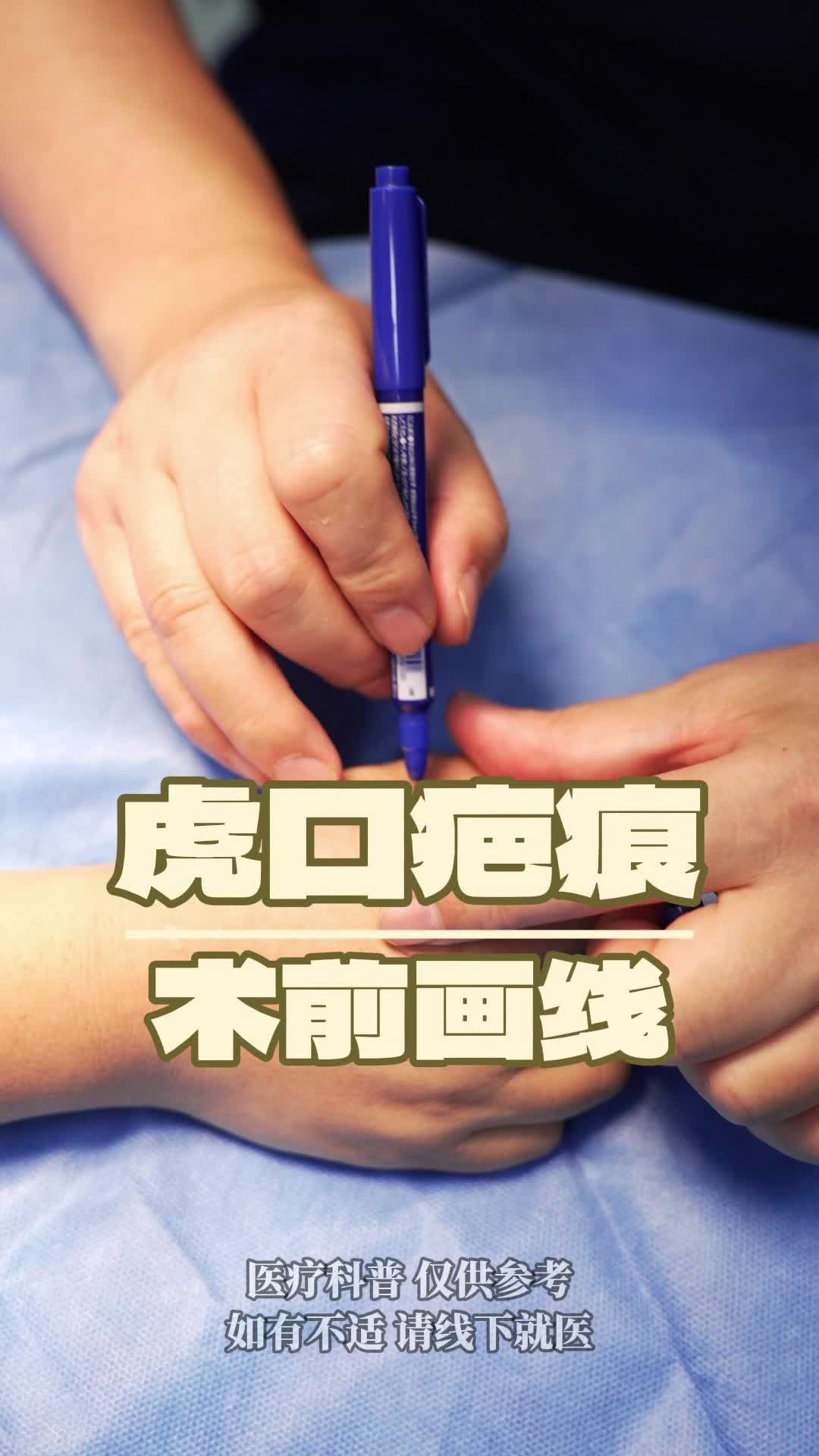 虎口疤痕术前切除画线中.