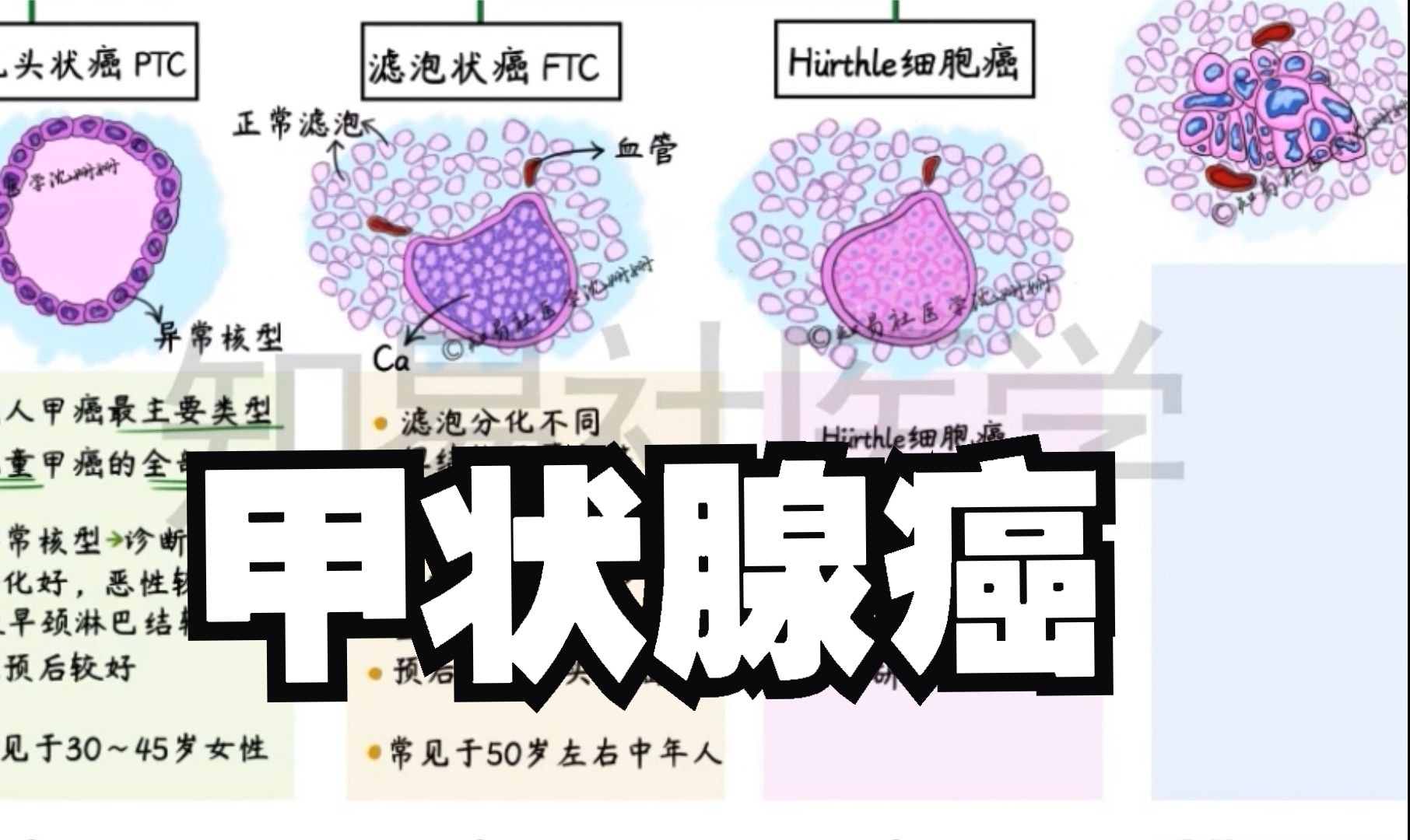 医学带背 甲状腺癌哔哩哔哩bilibili