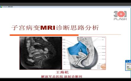 8子宫疾病MRI的诊断思路——王海屹哔哩哔哩bilibili