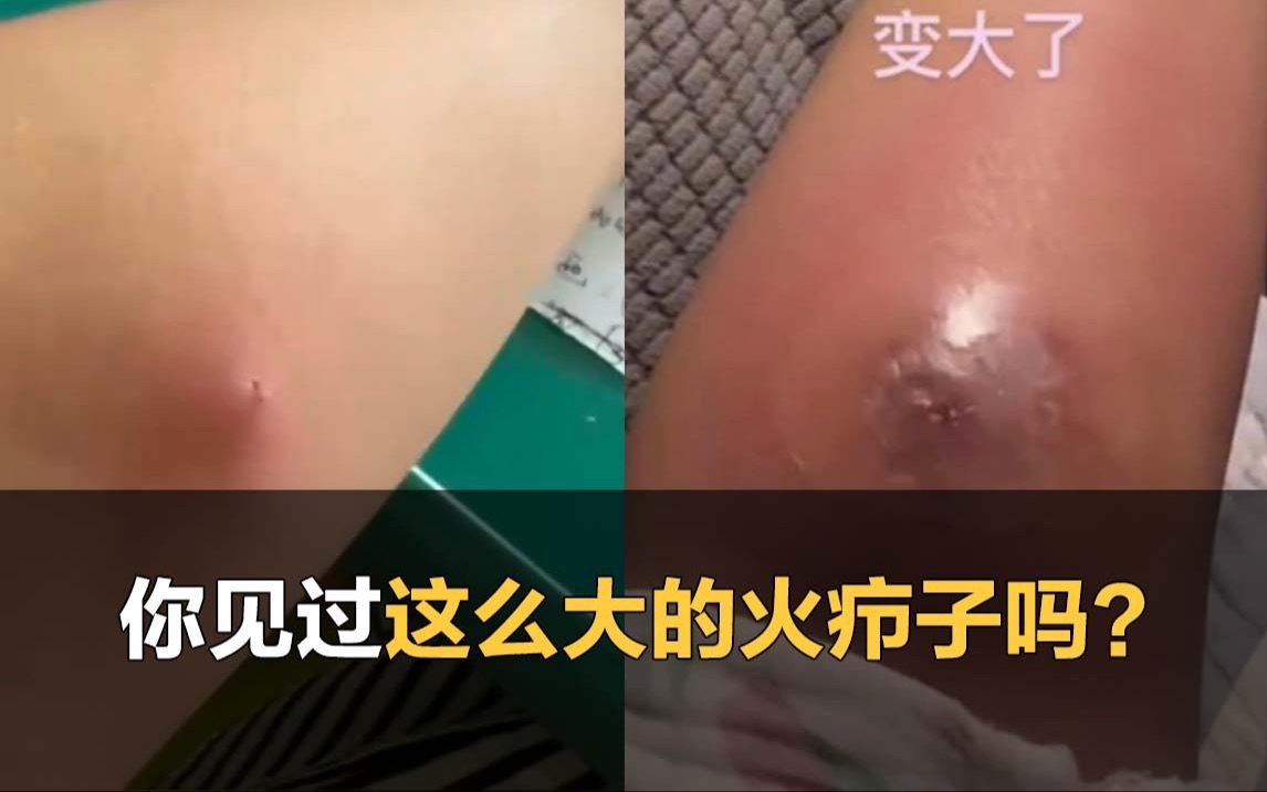 女生胳膊上长巨型疖肿,大到只能去医院切开哔哩哔哩bilibili