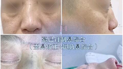 小时候受伤致歪鼻 双侧耳软骨鼻尖成型鼻背 成型中驼峰 歪鼻矫正术后即刻 所谓 十鼻九歪 有鼻骨偏斜和鼻中隔的歪斜 如不解决歪的问题 单纯垫鼻梁以后歪 就更明显 哔哩哔哩