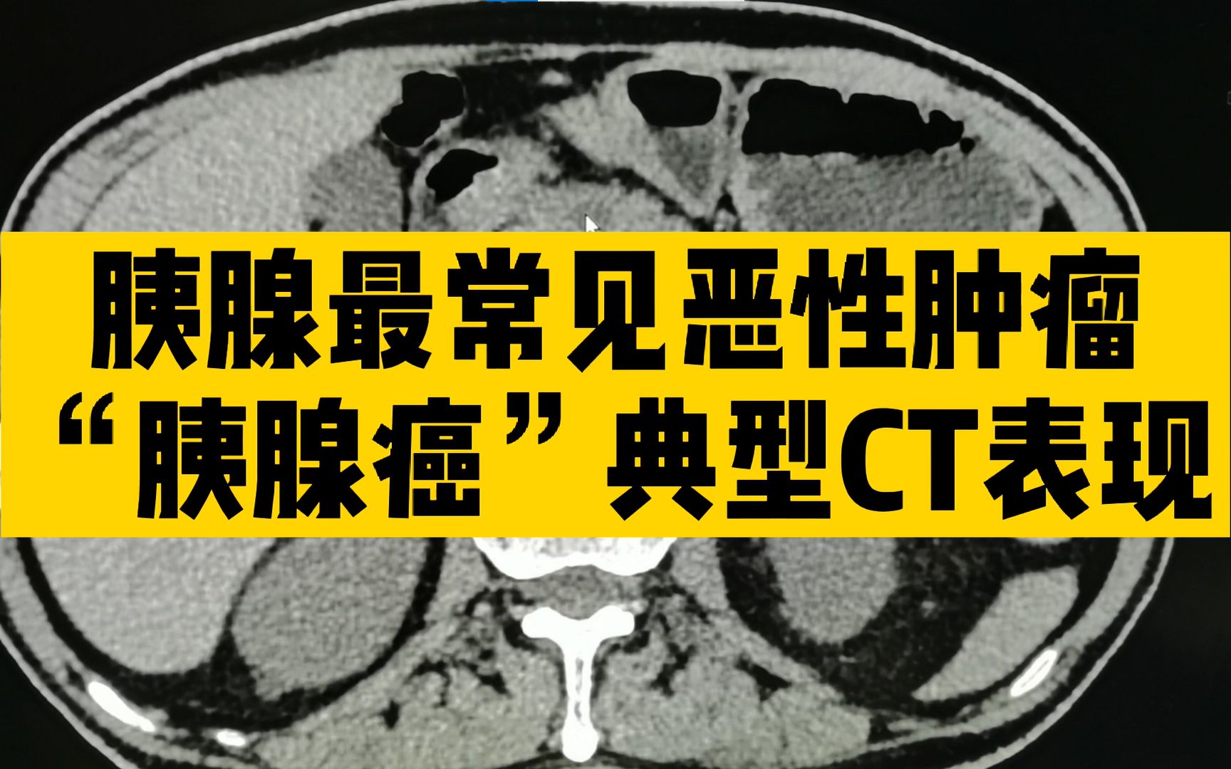 【基础知识】胰腺最常见恶性肿瘤胰腺癌典型CT表现哔哩哔哩bilibili