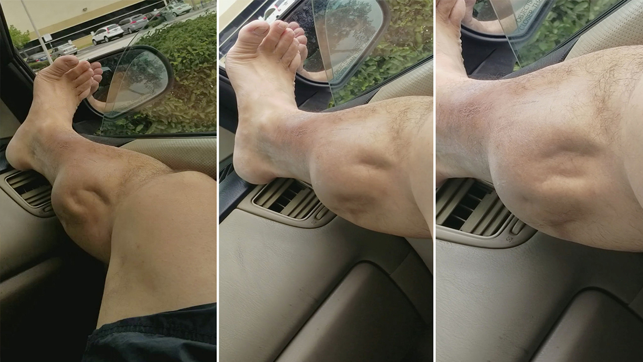 实拍男子腿肚抽筋直接凹成了一个大洞