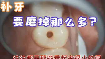 我就是补个牙，为什么反而要磨那么大的牙洞，牙齿都要毁了
