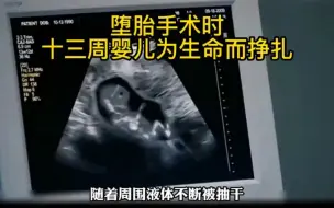 Download Video: 堕胎手术时，13周的婴儿为生命挣扎