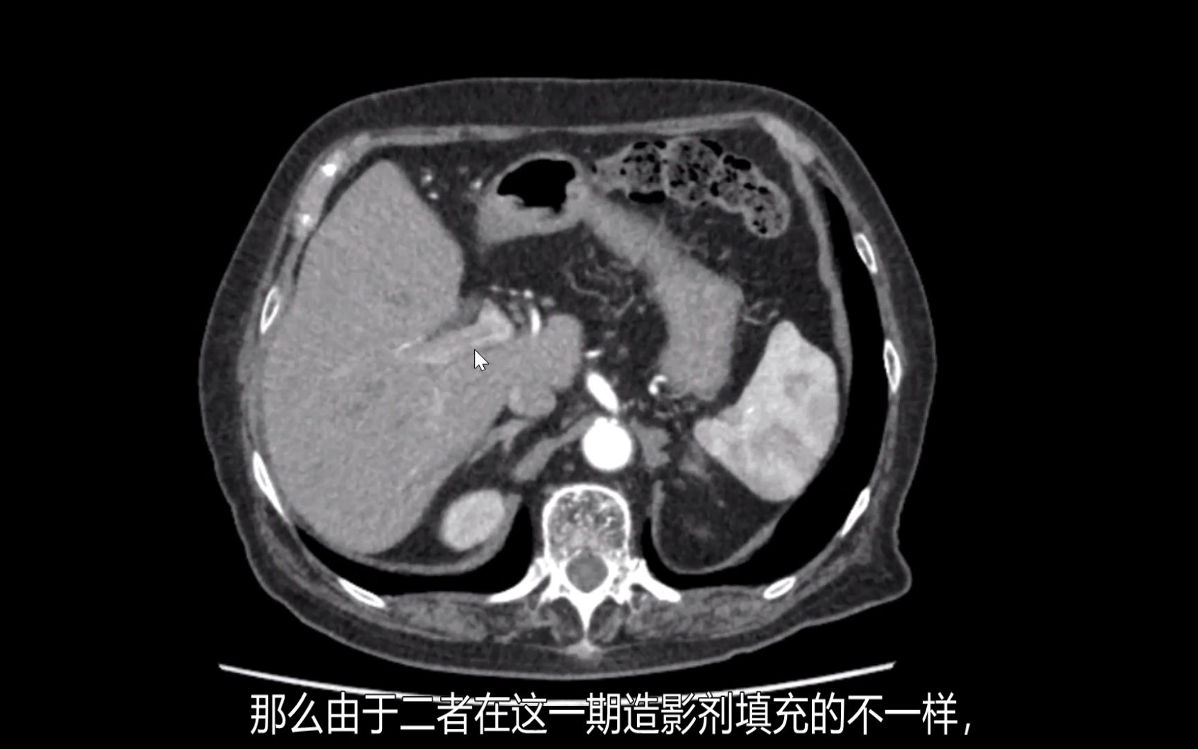 [图]上腹部增强动脉期，门静脉为何强化不均匀？血栓和瘤栓如何鉴别？