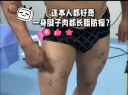隔空取物~全身多发性脂肪瘤