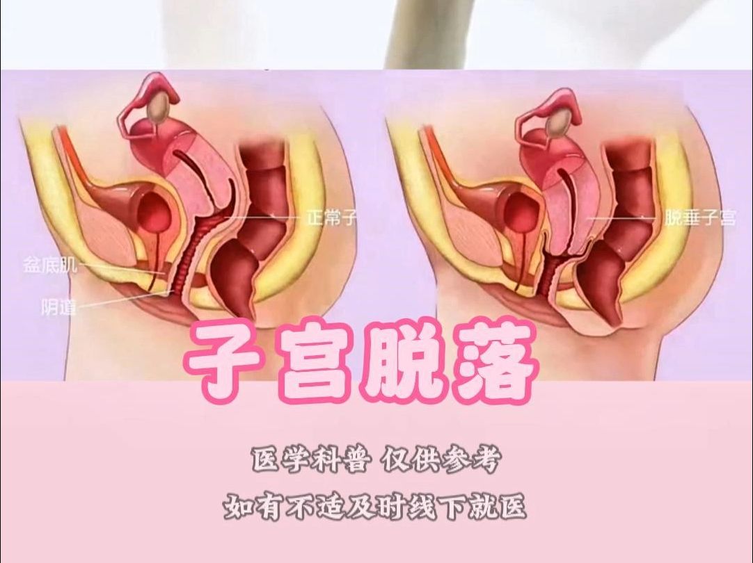 子宫脱垂 真实图片