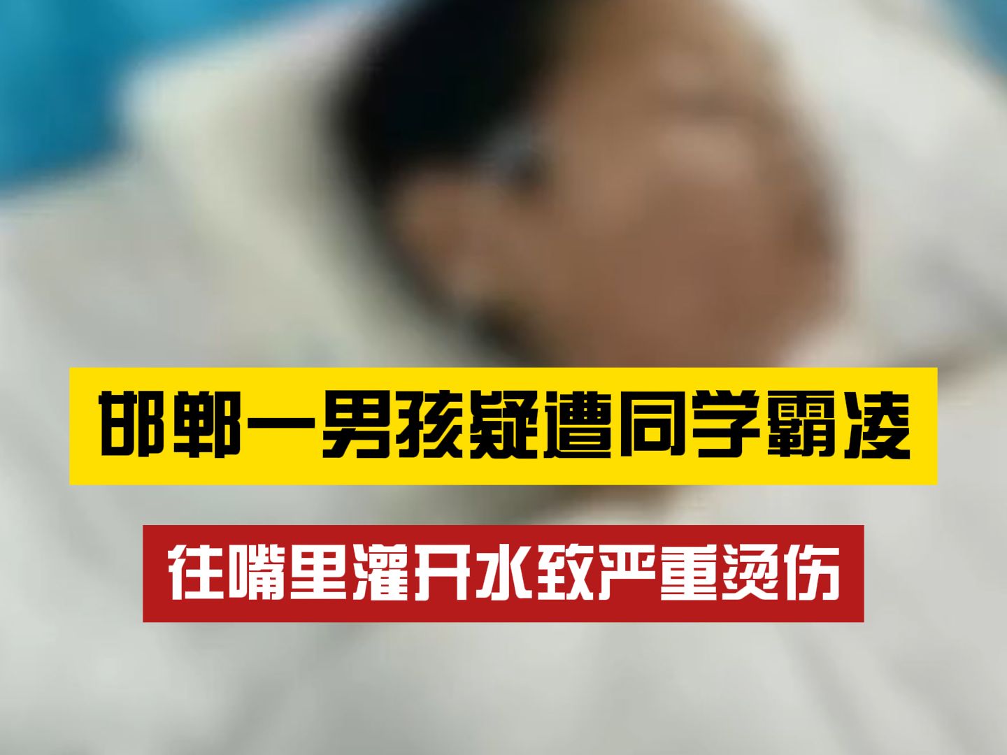 又是邯郸?一男孩被同学往嘴里灌开水严重烫伤就医哔哩哔哩bilibili