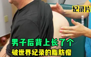 Download Video: 男子后背长了破纪录的肿块，网红李医生给它切除掉，实在太解压了