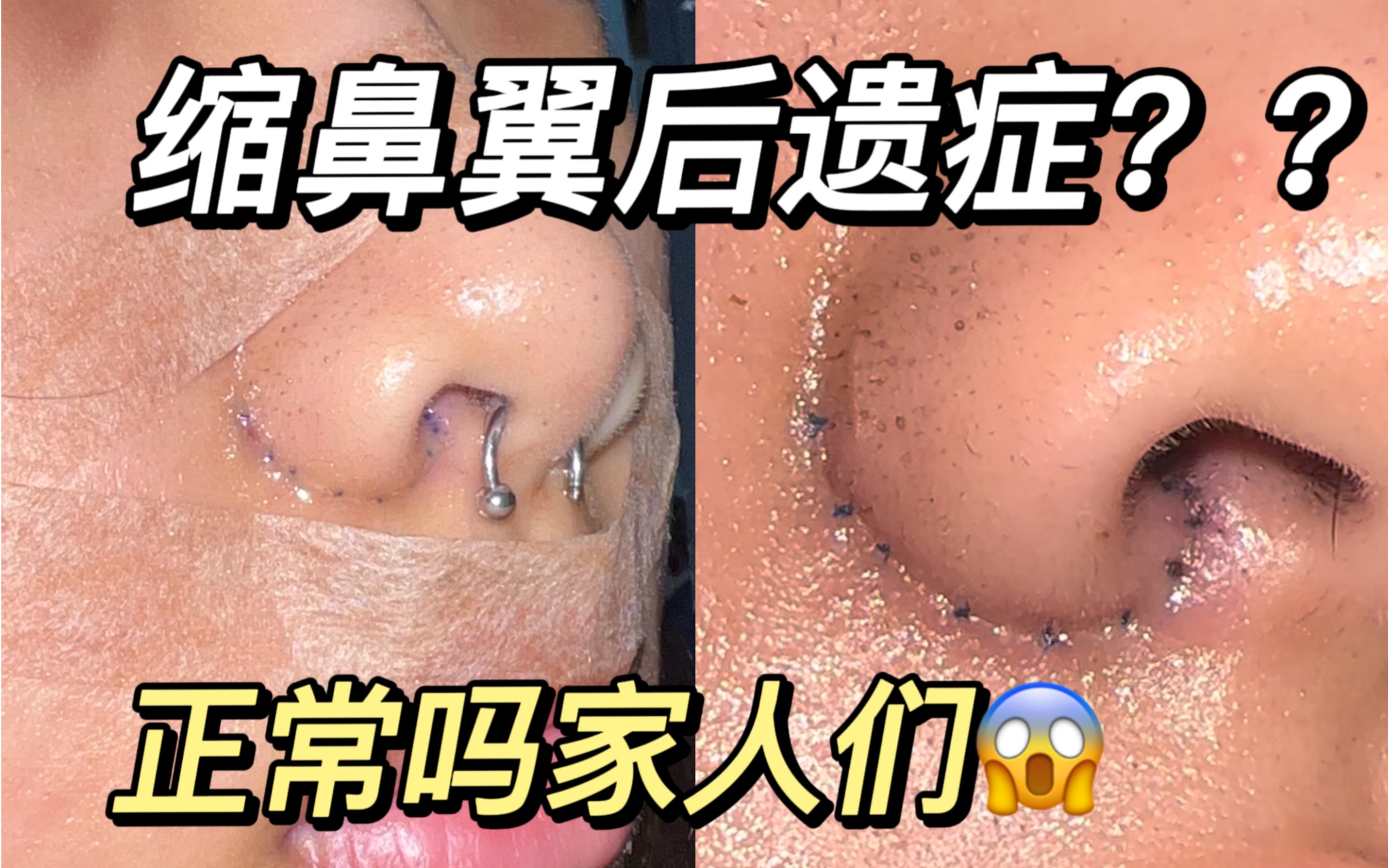 【医美分享】缩鼻翼后遗症!这正常吗家人们!